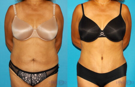 Tummy Tuck case #7233