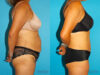 Tummy Tuck case #7233 slider thumbnail