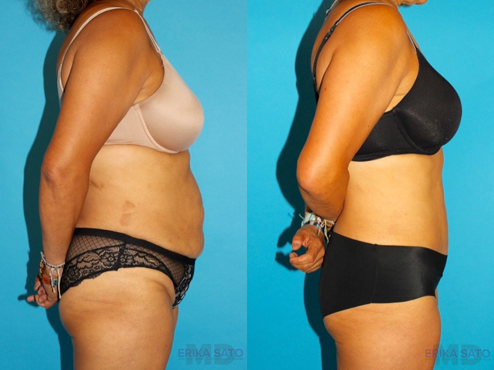 Tummy Tuck case #7233