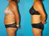 Tummy Tuck case #7233 slider thumbnail