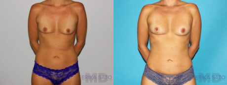 Fat Grafting to the Breast case #8051