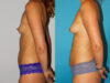 Fat Grafting to the Breast case #8051 slider thumbnail