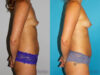Fat Grafting to the Breast case #8051 slider thumbnail