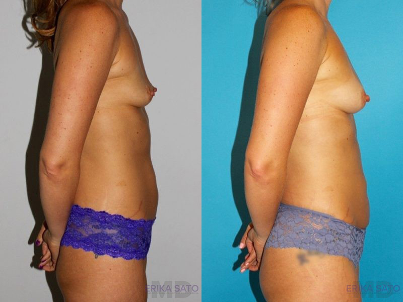 Fat Grafting to the Breast case #8051