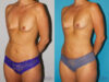 Fat Grafting to the Breast case #8051 slider thumbnail
