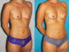 Fat Grafting to the Breast case #8051 slider thumbnail