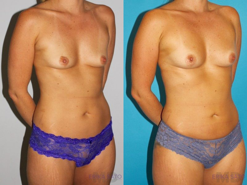 Fat Grafting to the Breast case #8051
