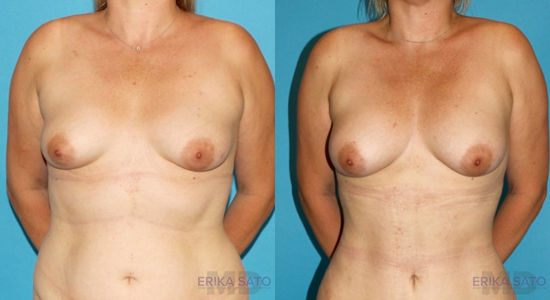 Fat Grafting to the Breast case #8044