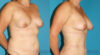 Fat Grafting to the Breast case #8044 slider thumbnail