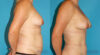 Fat Grafting to the Breast case #8044 slider thumbnail