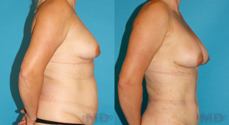 Fat Grafting to the Breast case #8044