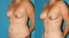 Fat Grafting to the Breast case #8044 slider thumbnail