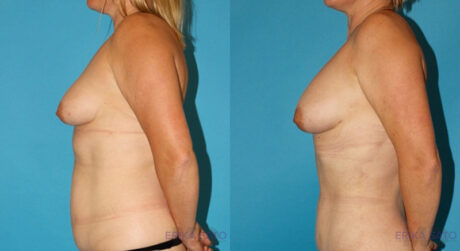 Fat Grafting to the Breast case #8044