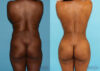 Brazilian Butt Lift case #4633 slider thumbnail