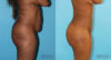 Brazilian Butt Lift case #4633 slider thumbnail