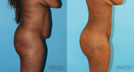 Brazilian Butt Lift case #4633