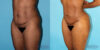 Brazilian Butt Lift case #4633 slider thumbnail