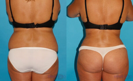 Tummy Tuck case #7280