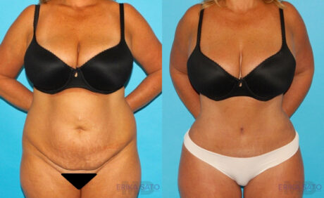 Tummy Tuck case #7280