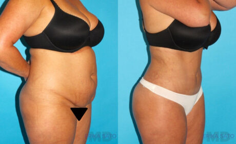 Tummy Tuck case #7280