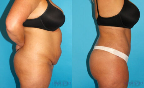 Tummy Tuck case #7280