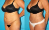 Tummy Tuck case #7280 slider thumbnail