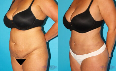 Tummy Tuck case #7280