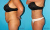 Tummy Tuck case #7280 slider thumbnail