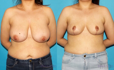 Breast Reduction case #7950
