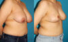 Breast Reduction case #7950 slider thumbnail