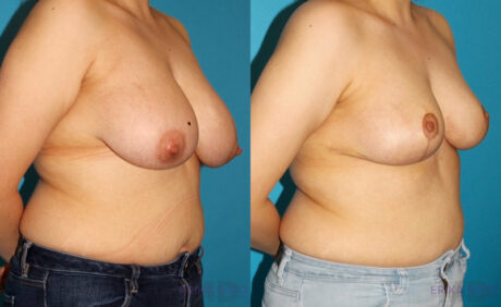 Breast Reduction case #7950