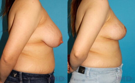 Breast Reduction case #7950