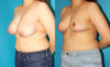 Breast Reduction case #7950 slider thumbnail