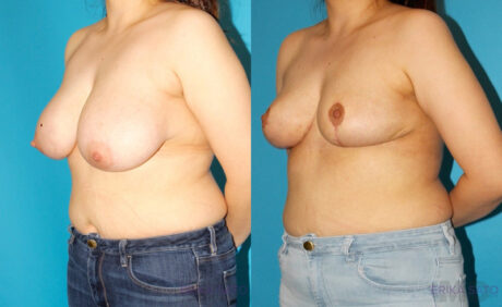 Breast Reduction case #7950