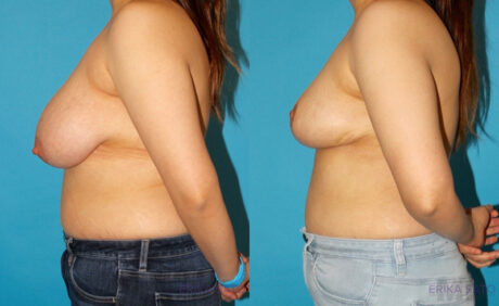 Breast Reduction case #7950