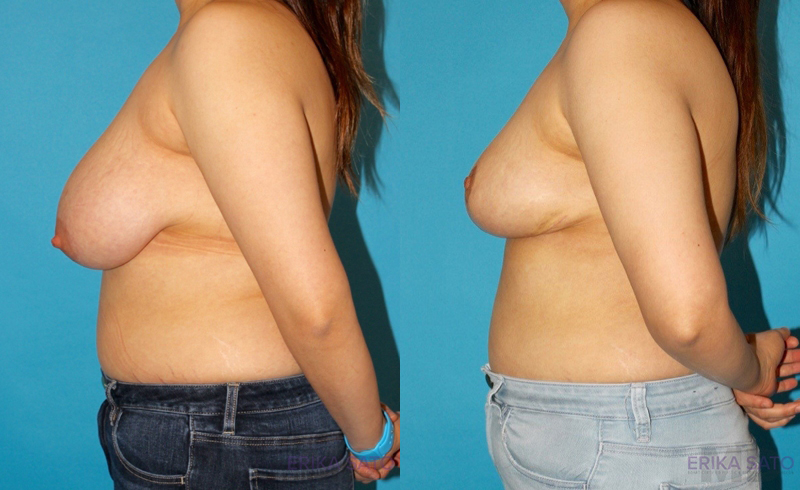 Breast Reduction case #7950