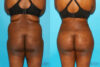 Brazilian Butt Lift case #4641 slider thumbnail