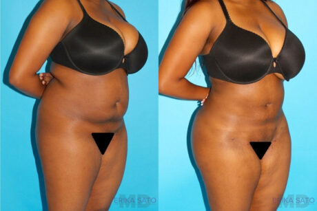 Brazilian Butt Lift case #4641