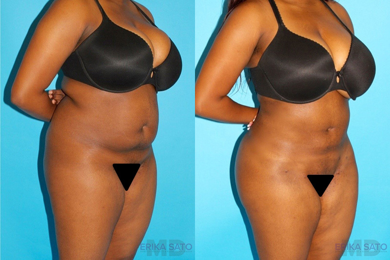 Brazilian Butt Lift case #4641