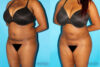Brazilian Butt Lift case #4641 slider thumbnail