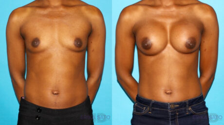 Breast Augmentation case #5666