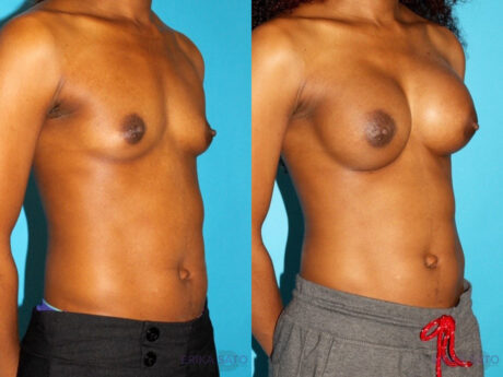 Breast Augmentation case #5666