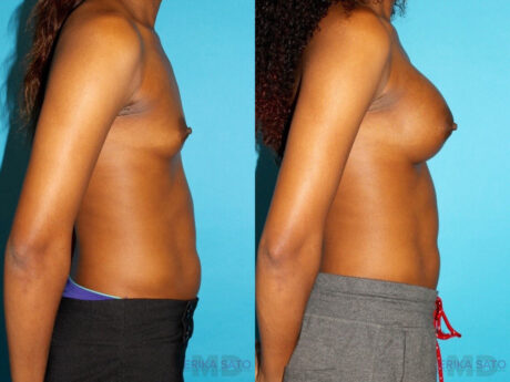 Breast Augmentation case #5666