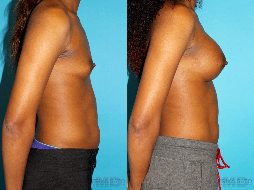 Breast Augmentation case #5666
