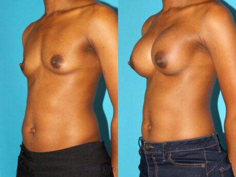 Breast Augmentation case #5666