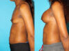 Breast Augmentation case #5666 slider thumbnail