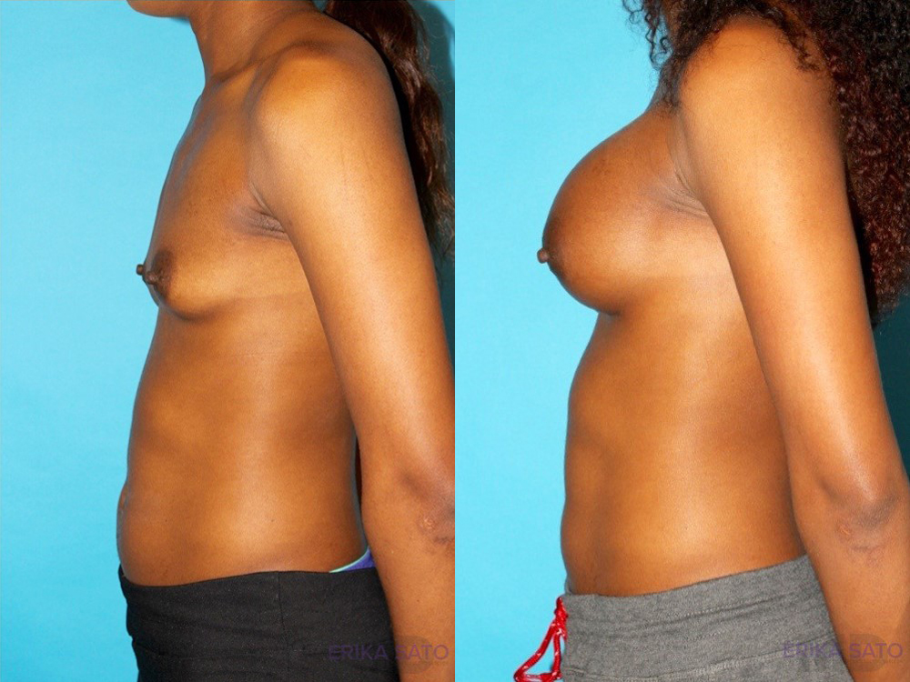 Breast Augmentation case #5666