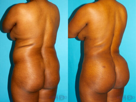 Brazilian Butt Lift case #4642