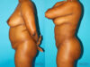 Brazilian Butt Lift case #4642 slider thumbnail