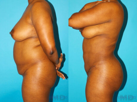 Brazilian Butt Lift case #4642